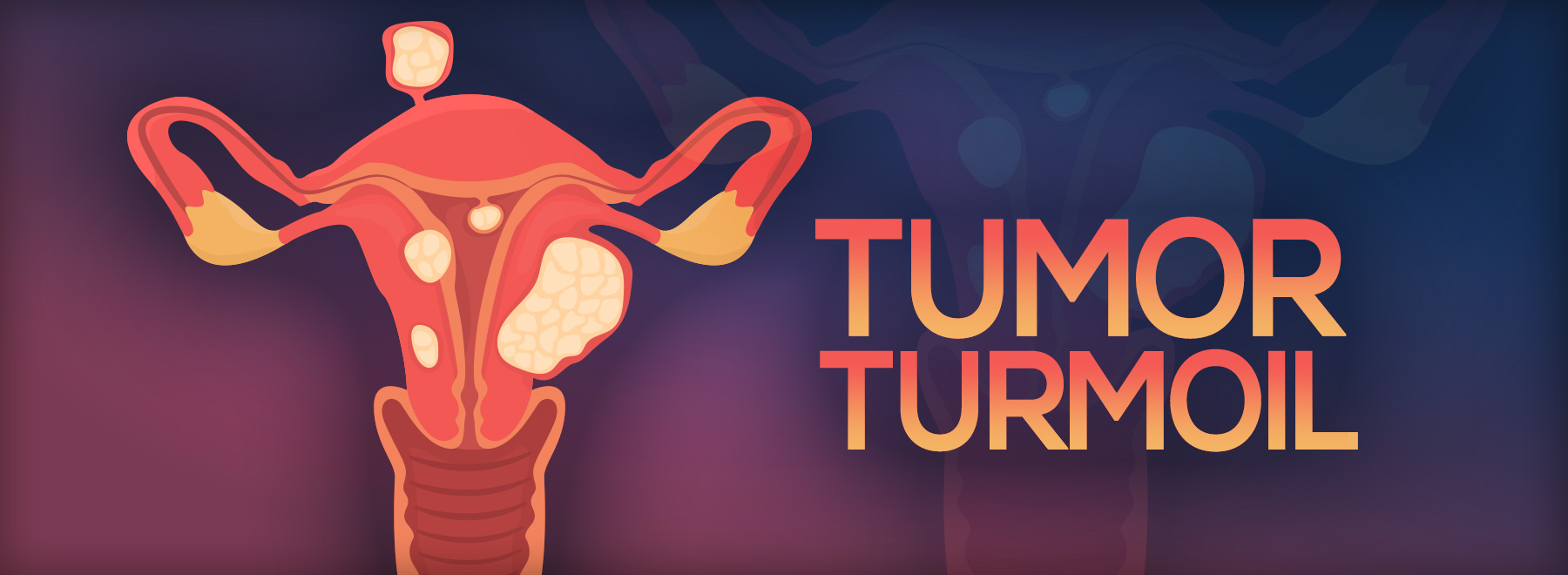 Illustration of Uterus with different fibroids